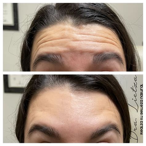 Resultados De Botox Fotos Antes Y Después Dra Lietza Salud Y Belleza