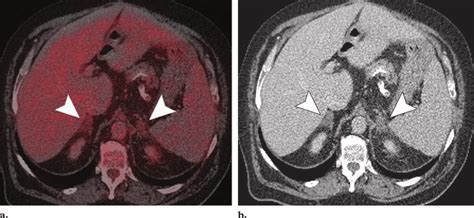 Adrenal Adenoma A Fused Pet Ct Scan Shows Bilateral Lesions