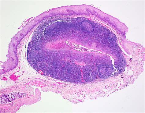 Pathology Outlines Lingual Tonsil