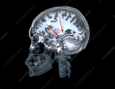 Brain In Alzheimers Disease Mri Stock Image C0269958 Science