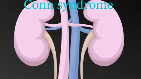 How To Diagnose Conns Syndrome YouTube