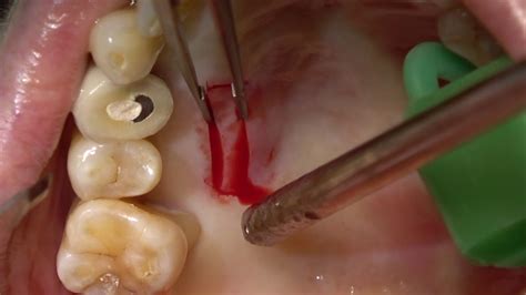 Mixed Epithelial Connective Tissue Graft Harvesting From Palate YouTube
