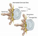 Best Treatment For Herniated Disc In Neck Images