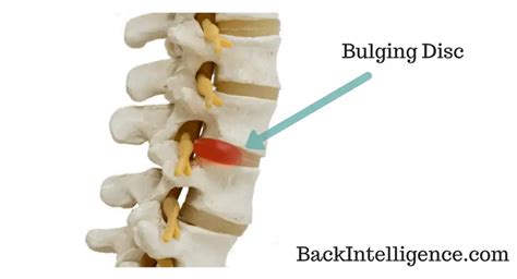 Bulging Disc Exercises In Lower Back Do These At Home