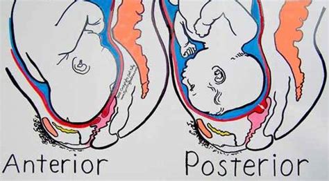 Baby In Posterior Position Births My Pregnant Health