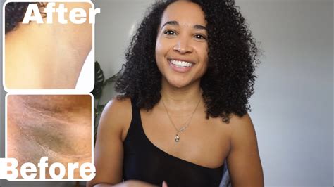 How I Lighten And Get Rid Of My Dark Armpits Fast Youtube