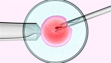 Intracytoplasmic Sperm Injection Icsi Dr Dhaval Dharani