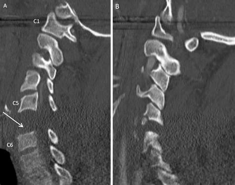 Cervical Spinous Process Fracture Icd 10