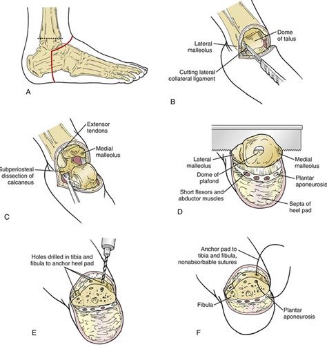 Amputation Causes Types Of Amputation And Amputation Complications