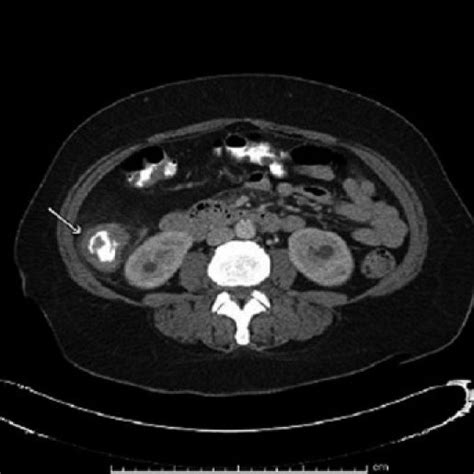 Ct Scan Of Abdomen With Contrast With Apple Core Lesion In Ascending
