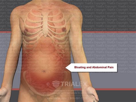 Bloating And Abdominal Pain Trial Exhibits Inc