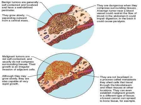 Benign And Malignant Tumor Comparison