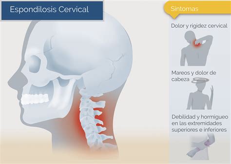 Espondilosis Cervical Neurocirugía De La Torre