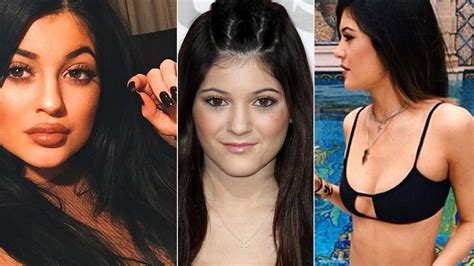 Plastic Surgeons Weigh In On Kylie Jenners Dramatic Transformation—did
