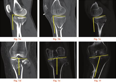 Reliability And Repeatability Of Tibial Plateau Fracture Assessment
