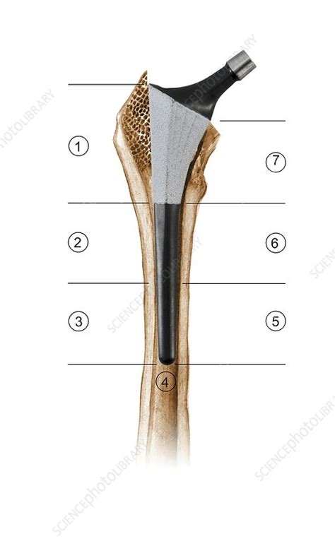 Prosthetic Hip Joint And Gruen Zones Stock Image C0166778