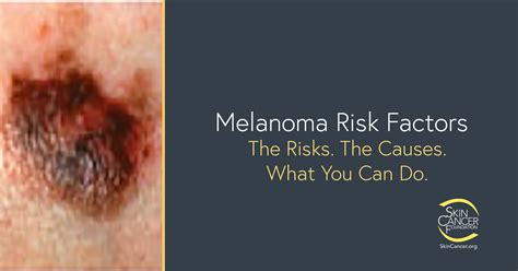 Melanom Risikofaktoren The Skin Cancer Foundation