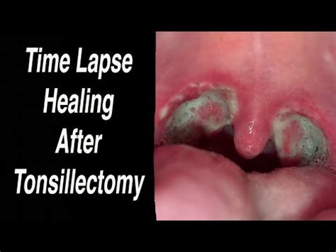 Tonsillectomy Time Lapse Healing Day By Day From Day Day Youtube