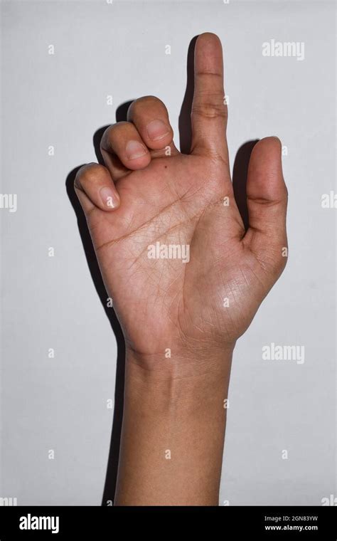 Ulnar Claw Hand Of Asian Young Woman Also Known As Spinsters Claw