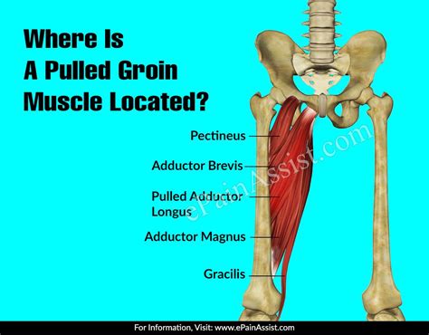 Groin Pain Diagram