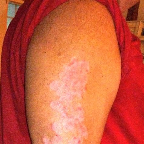 Viral Psoriasis When A Virus Causes Or Triggers Psoriasis