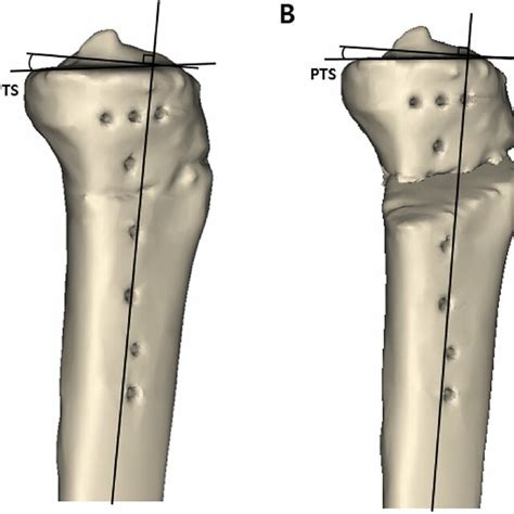 Measurement Of The Posterior Tibial Slope In A True Lateral Position