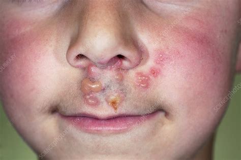 Impetigo Skin Infection In A Child Stock Image C0119519 Science