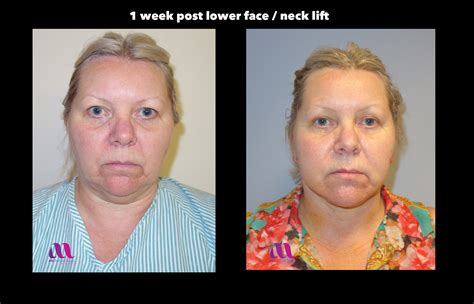 Lower Face Neck Lift A M Aesthetic Surgery