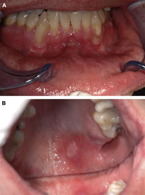 Oral Syphilis A Series Of 5 Cases Journal Of Oral And Maxillofacial