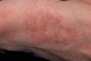 Heat rash is also called miliaria rubra, miliaria crystallina, summer rash or prickly heat. Heat rash (prickly heat) | nidirect