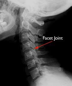 Many people have cervical spodylosis that has yet to be diagnosed. Cervical Spondylosis (Arthritis of the Neck) - OrthoInfo ...