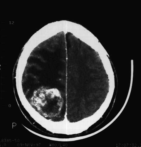 Brain Neoplasms Brain Cancer Brain Tumors Cancer Of Brain Malignant