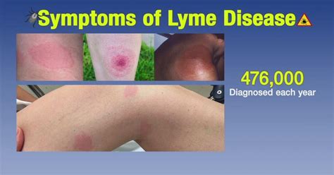 Ticked Off What You Need To Know About Lyme Disease Life Lessons