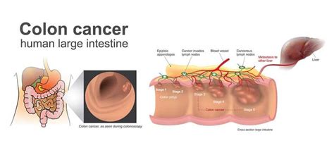 Colon Cancer Stages Symptoms Causes Screening And Colon Cancer Treatment
