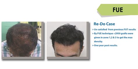 Hair transplant in karachi is one of the best service provided by the karachi hair traansplant. FUE Hair Transplant before after | KHT Best Hair ...