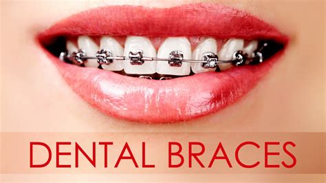 Different Types Of Dental Braces For Your Teeth Youtube