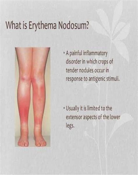 Erythema Nodosum Nurse Info