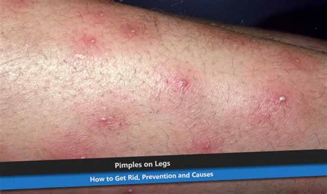 Pimples On Legs How To Get Rid Prevention And Causes