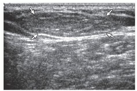 Lipoma Ultrasound Image Shows Oval Hyperechoic Subcutaneous Lipoma