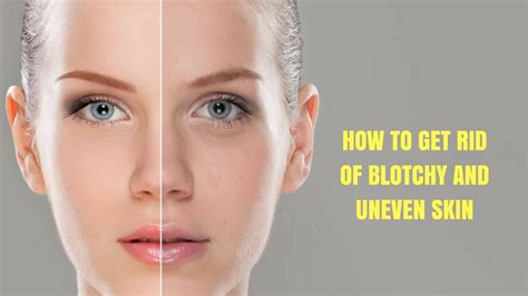 How To Get Rid Of Blotchy And Uneven Skin Youtube