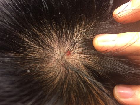 Red Brown Spots On Scalp