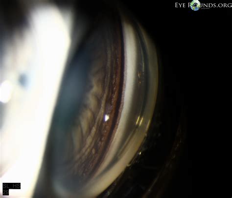 Pigmentary Glaucoma