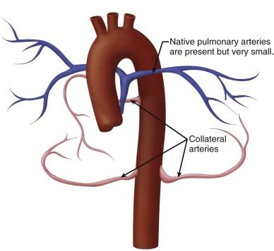 Collateral is normally classified in order to simplify risk management and reporting. Tetralogy of Fallot with Pulmonary Atresia | Radiology Key