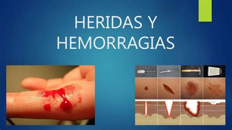 Hemorragias Y Heridas