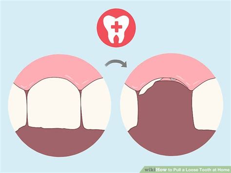 How to pull a tooth yourself? 12 Ways to Pull a Loose Tooth at Home - wikiHow