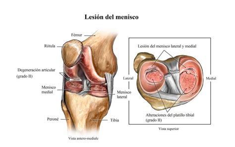 lesión de menisco de la rodilla causas y síntomas pruebas