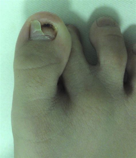 How long it would take to grow back and will it be normal once grown?. All About Your Child » Blog Archive » Toe Nail Falling Off