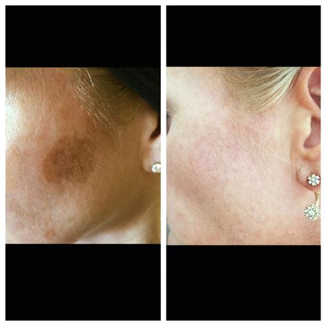 Before And After Whole Body Cryotherapy Alison King Cryotherapy