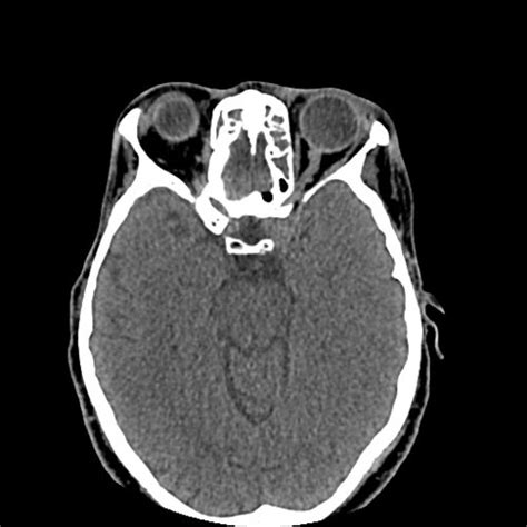 Cranium Skull Head And Neck Cts