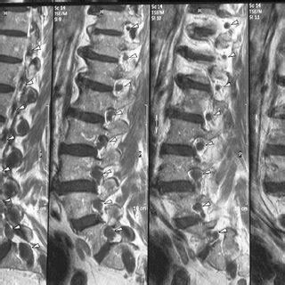 Patient I:1 spinal MRI of the lumbosacral spinal tract (T1 ...